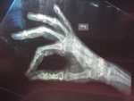 X ray of hand