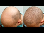 Hair Restoration
