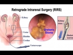 RIRS Kidney Stone Treatment by Dr. Yusuf Saifee: The Future of Stone Removal
